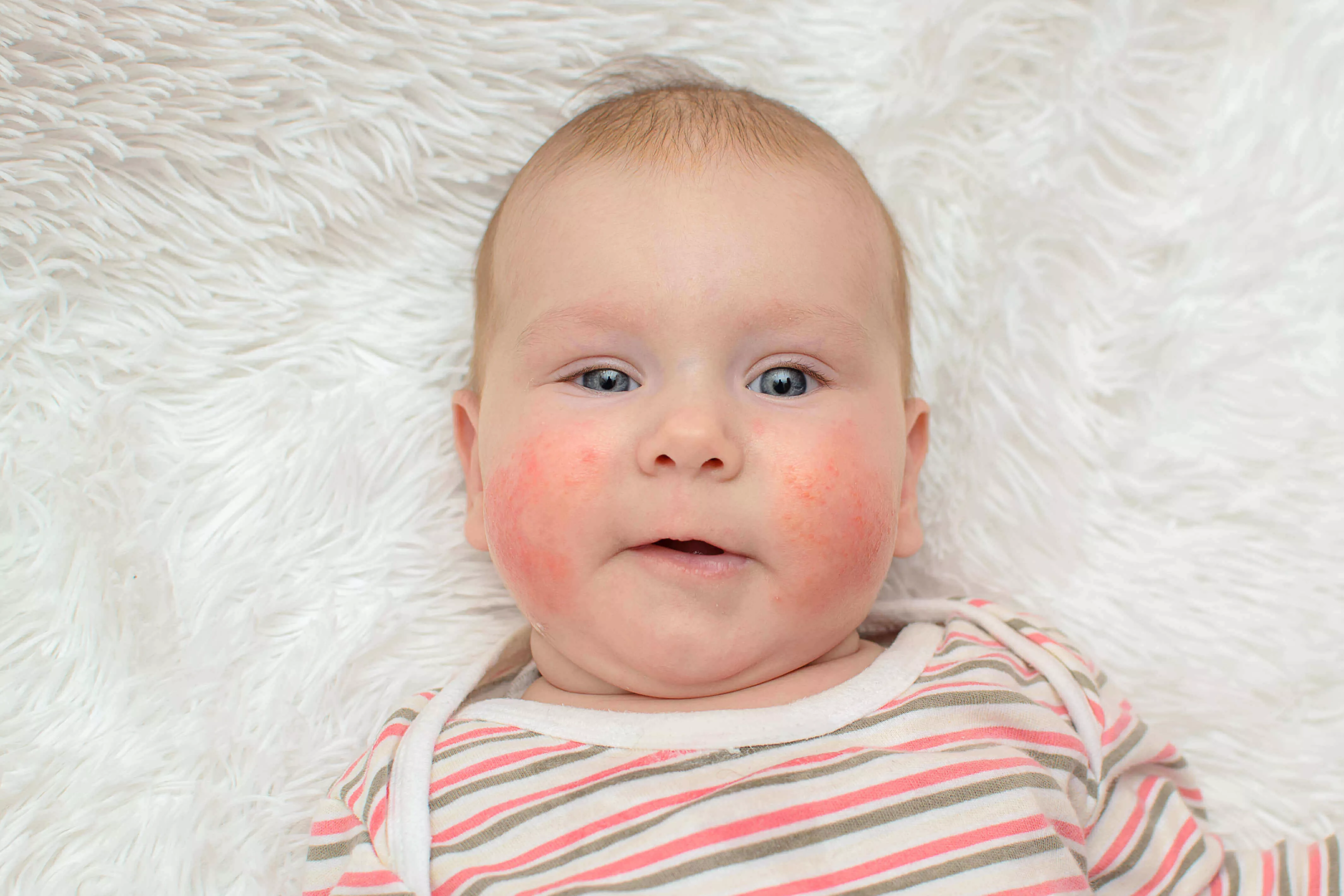 bebeklerde Atopik Dermatit